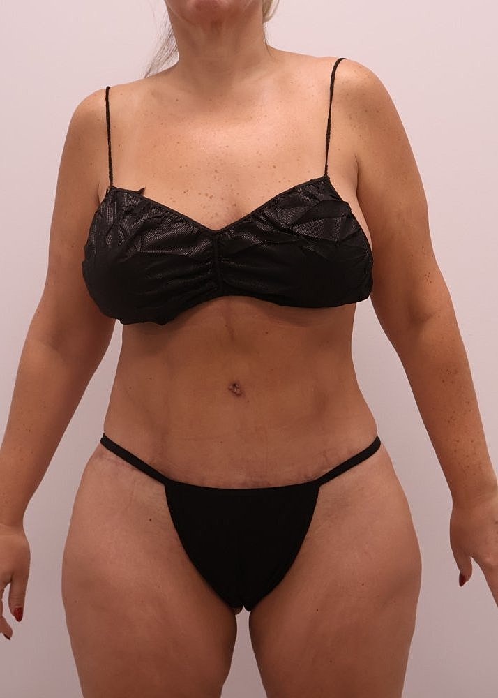 MEDICAL WEIGHT LOSS PROGRAM Before & After