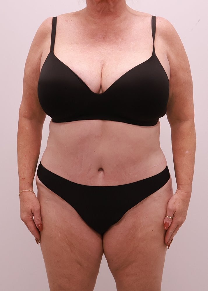 MEDICAL WEIGHT LOSS PROGRAM Before & After