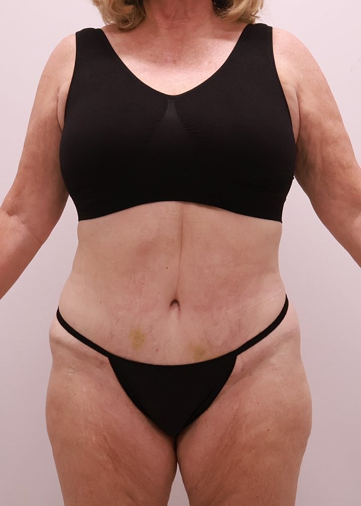 MEDICAL WEIGHT LOSS PROGRAM Before & After