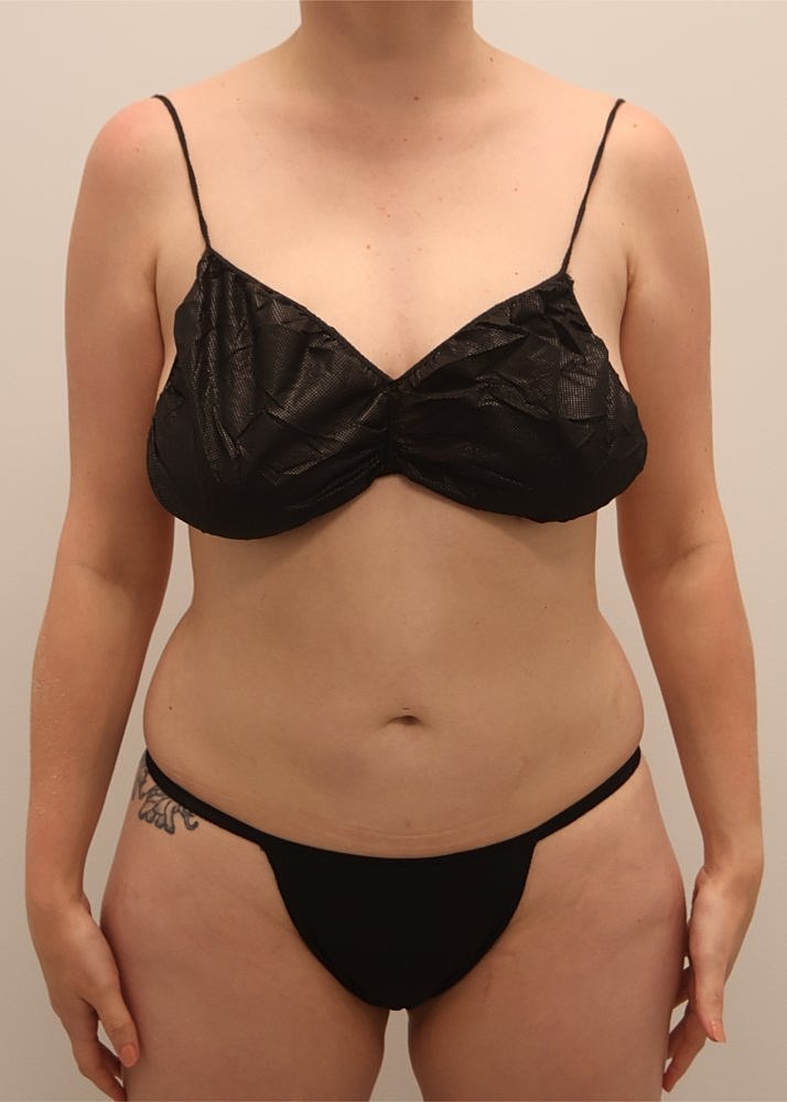 MEDICAL WEIGHT LOSS PROGRAM Before & After