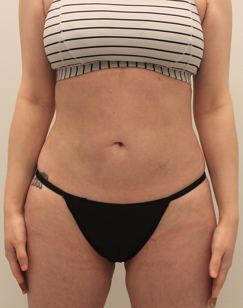 MEDICAL WEIGHT LOSS PROGRAM Before & After