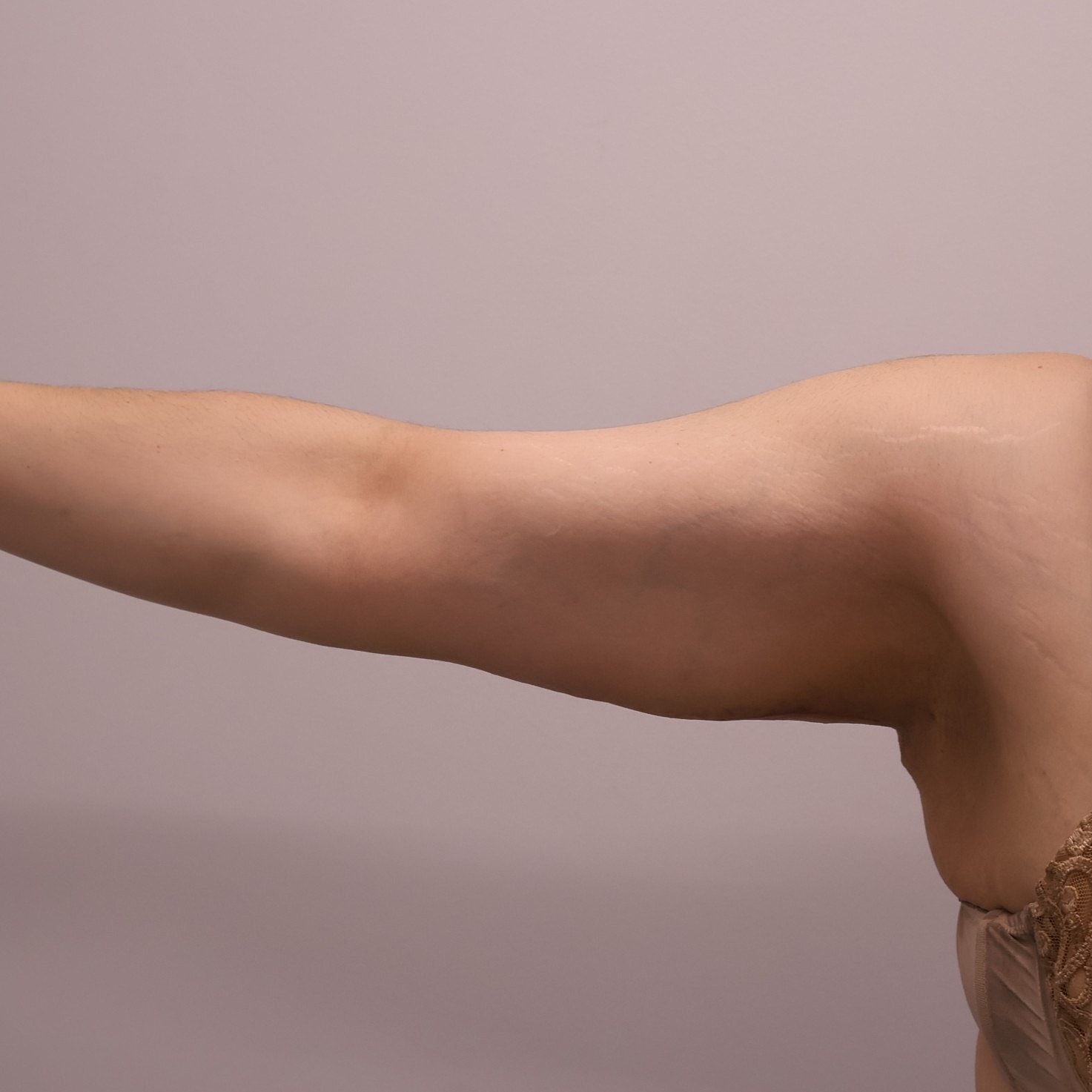 Arm Lift Before & After