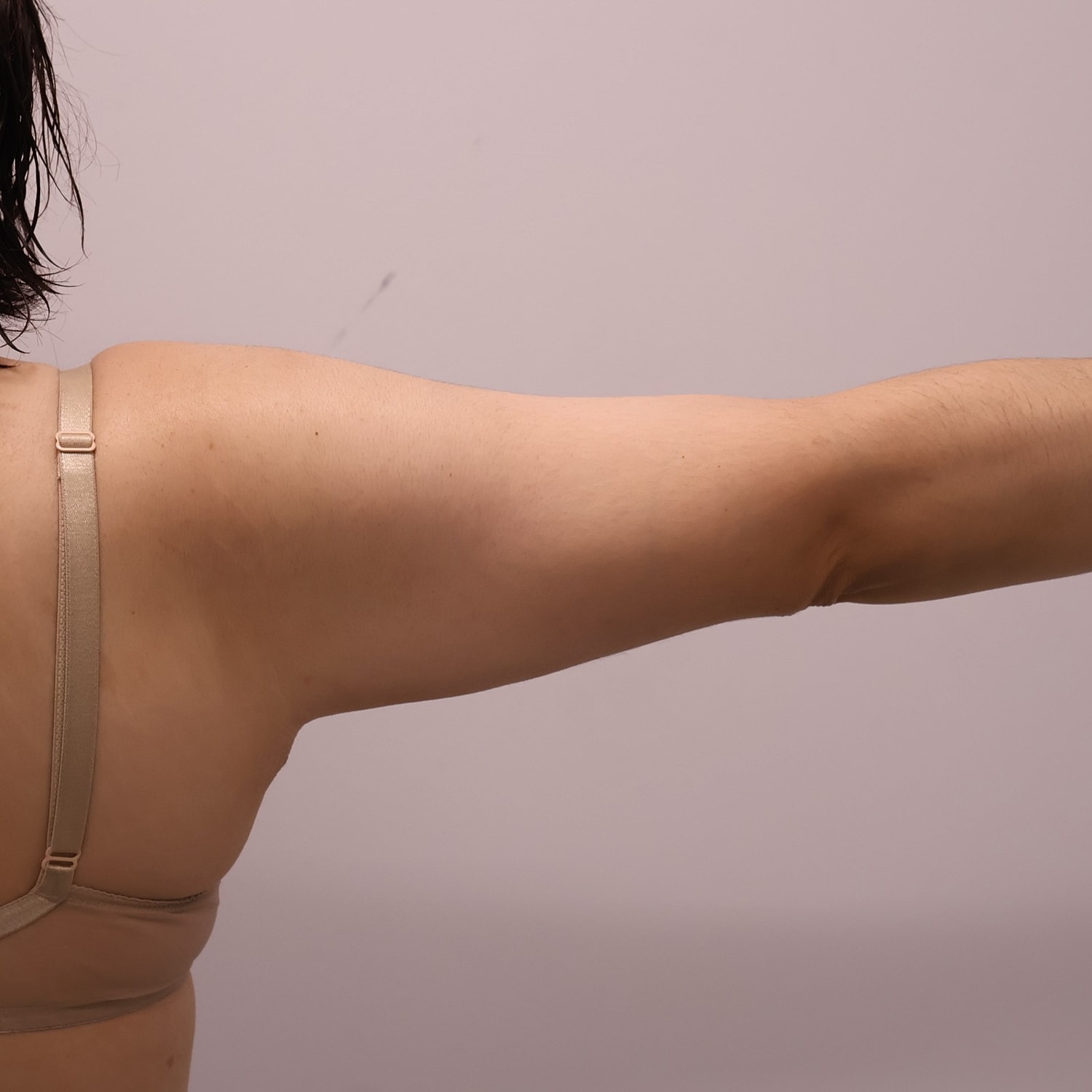 Arm Lift Before & After