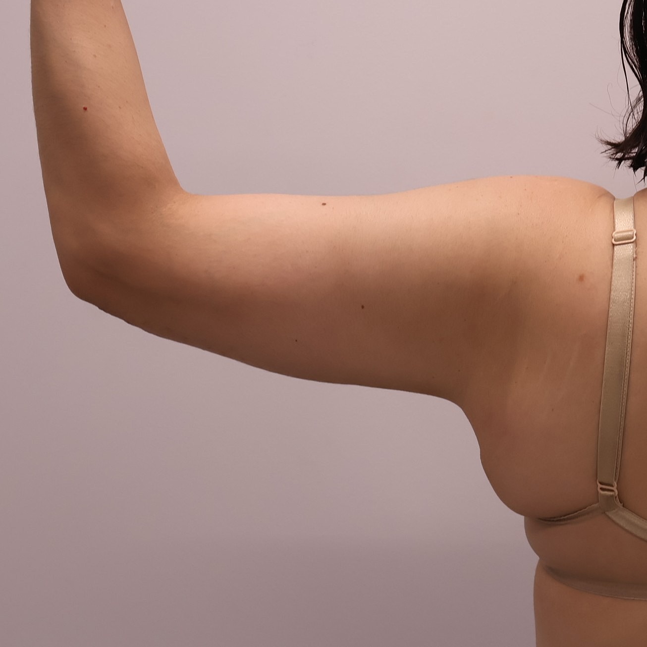 Arm Lift Before & After