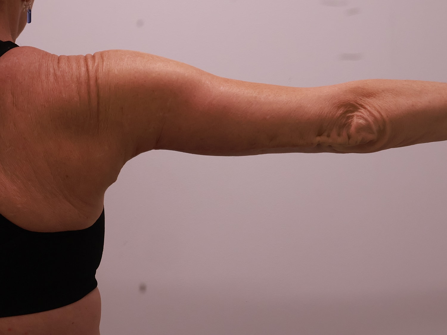 Arm Lift Before & After