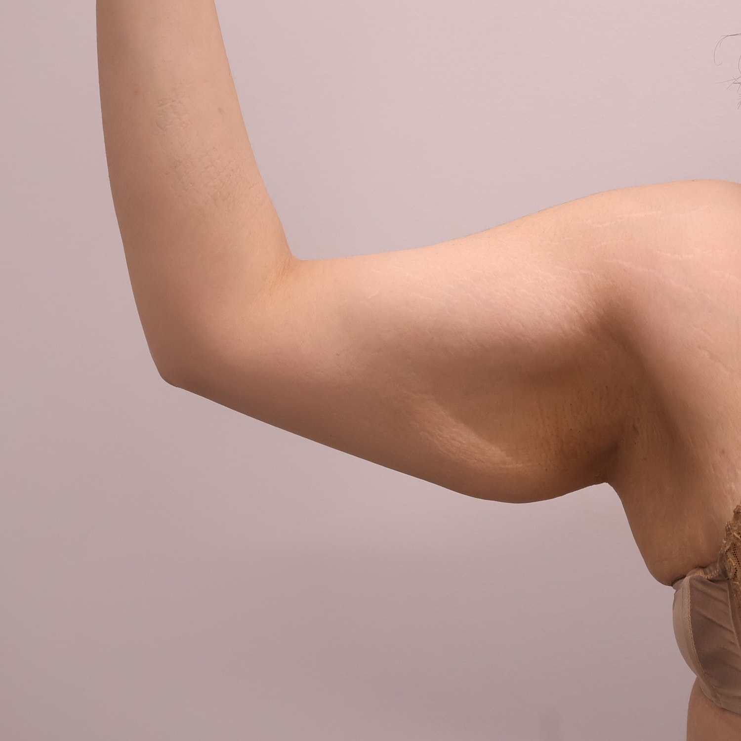 Arm Lift Before & After