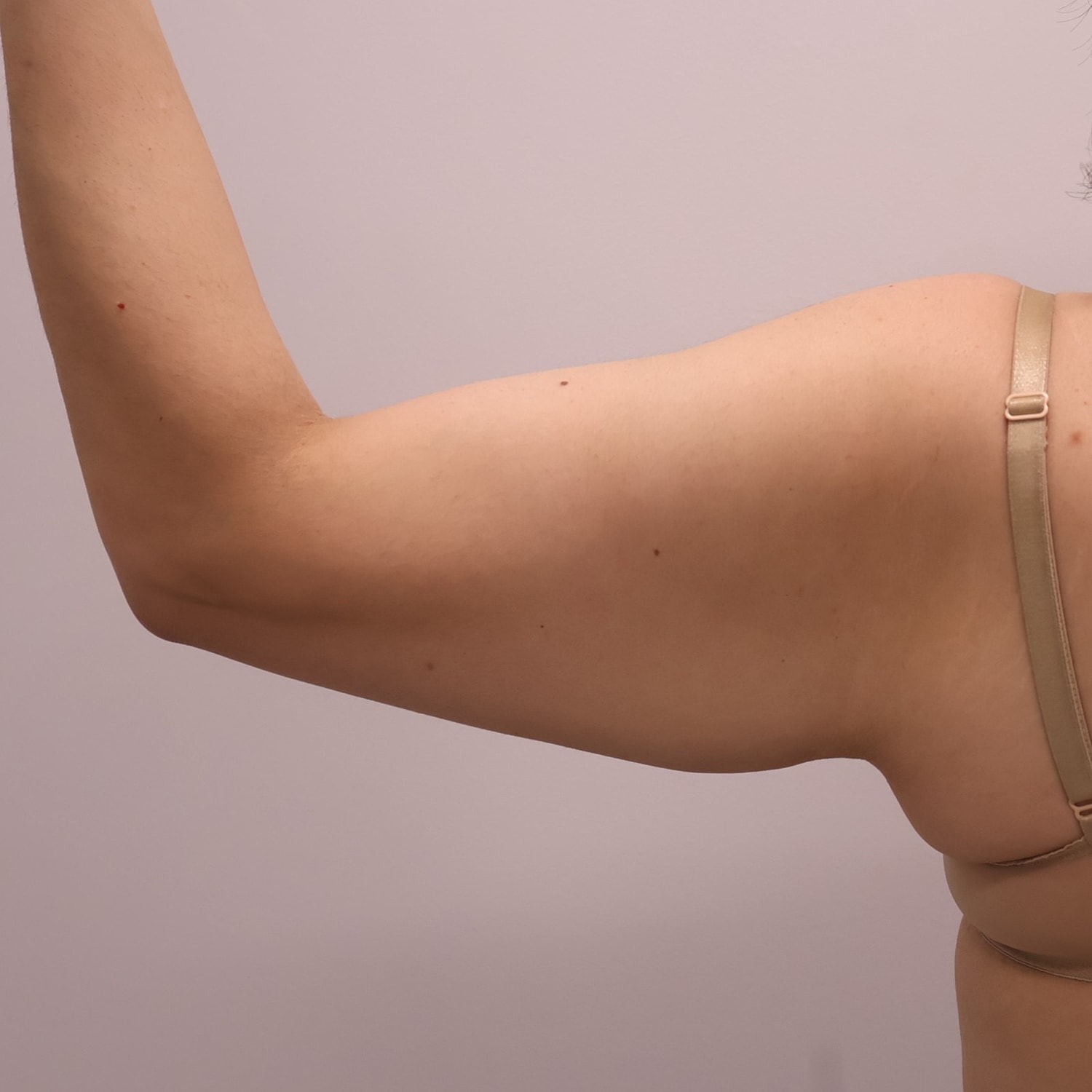 Arm Lift Before & After