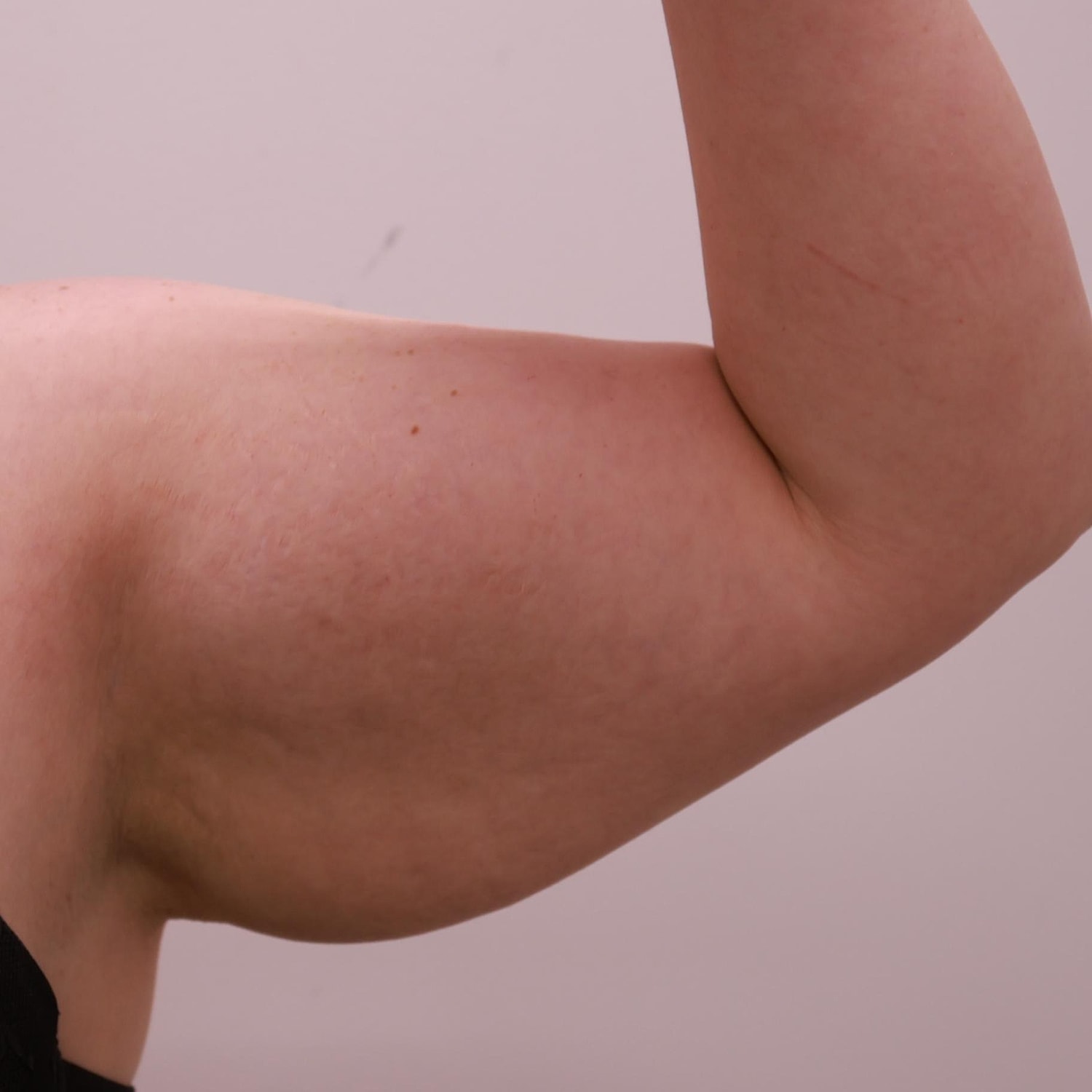 Arm Lift Before & After