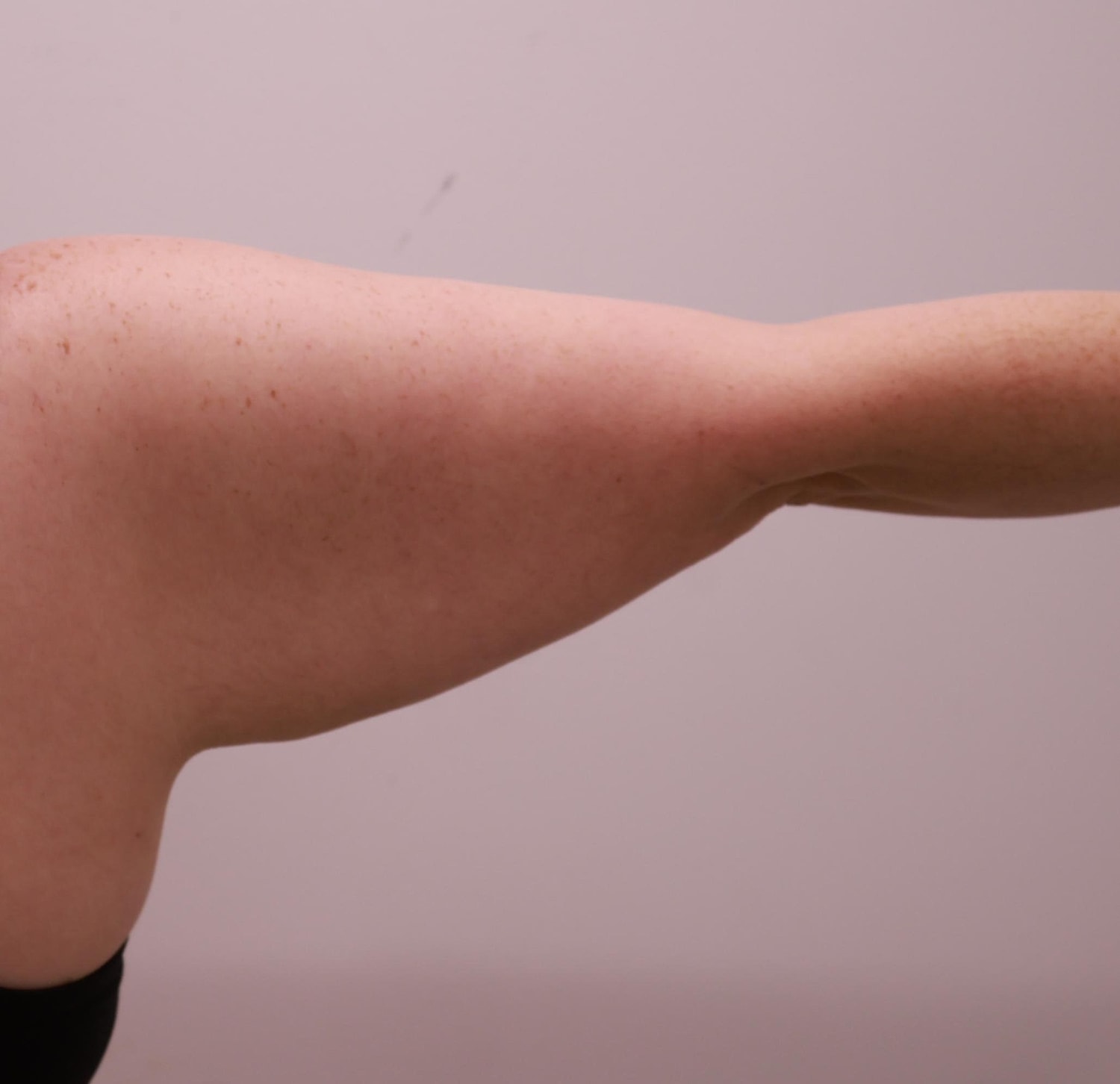 Arm Lift Before & After