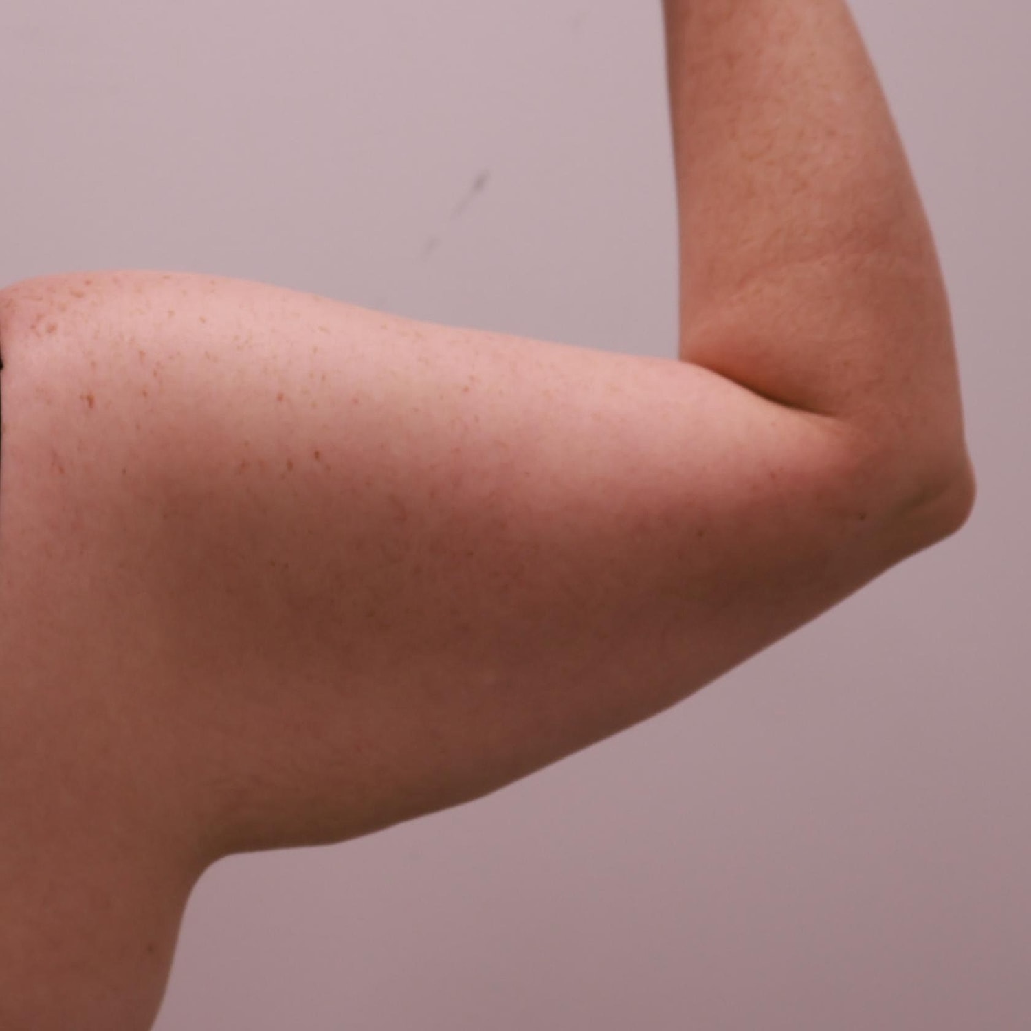 Arm Lift Before & After