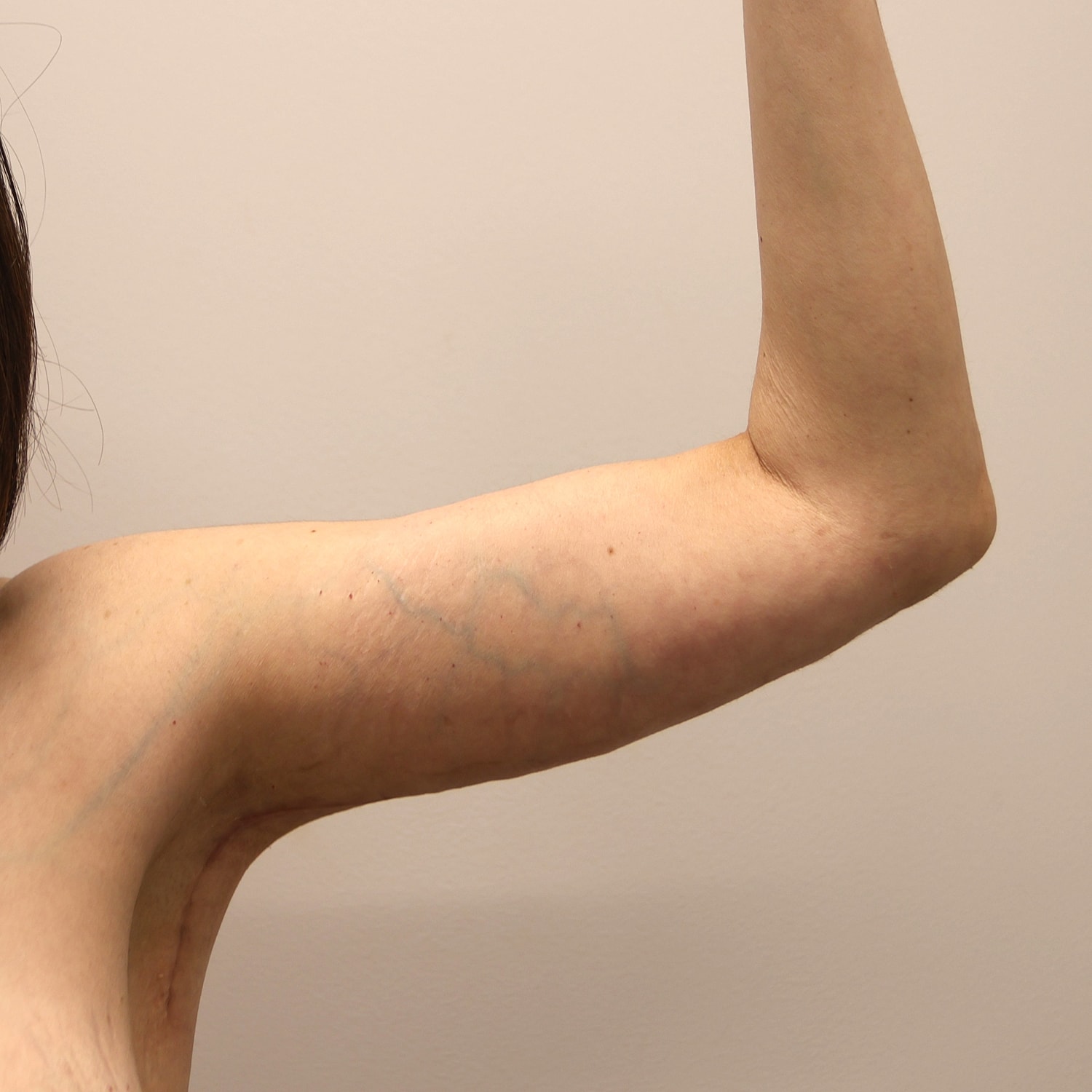 Arm Lift Before & After