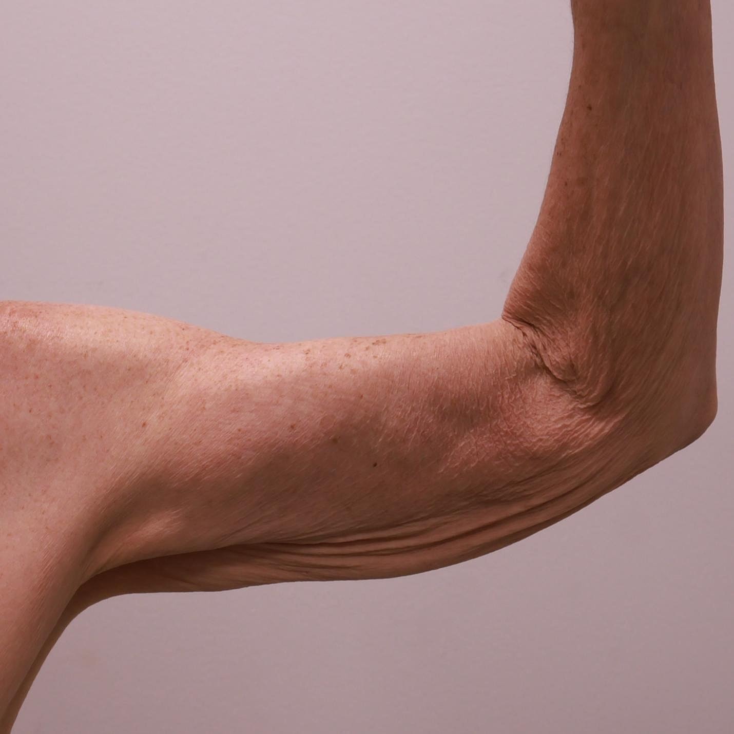 Arm Lift Before & After