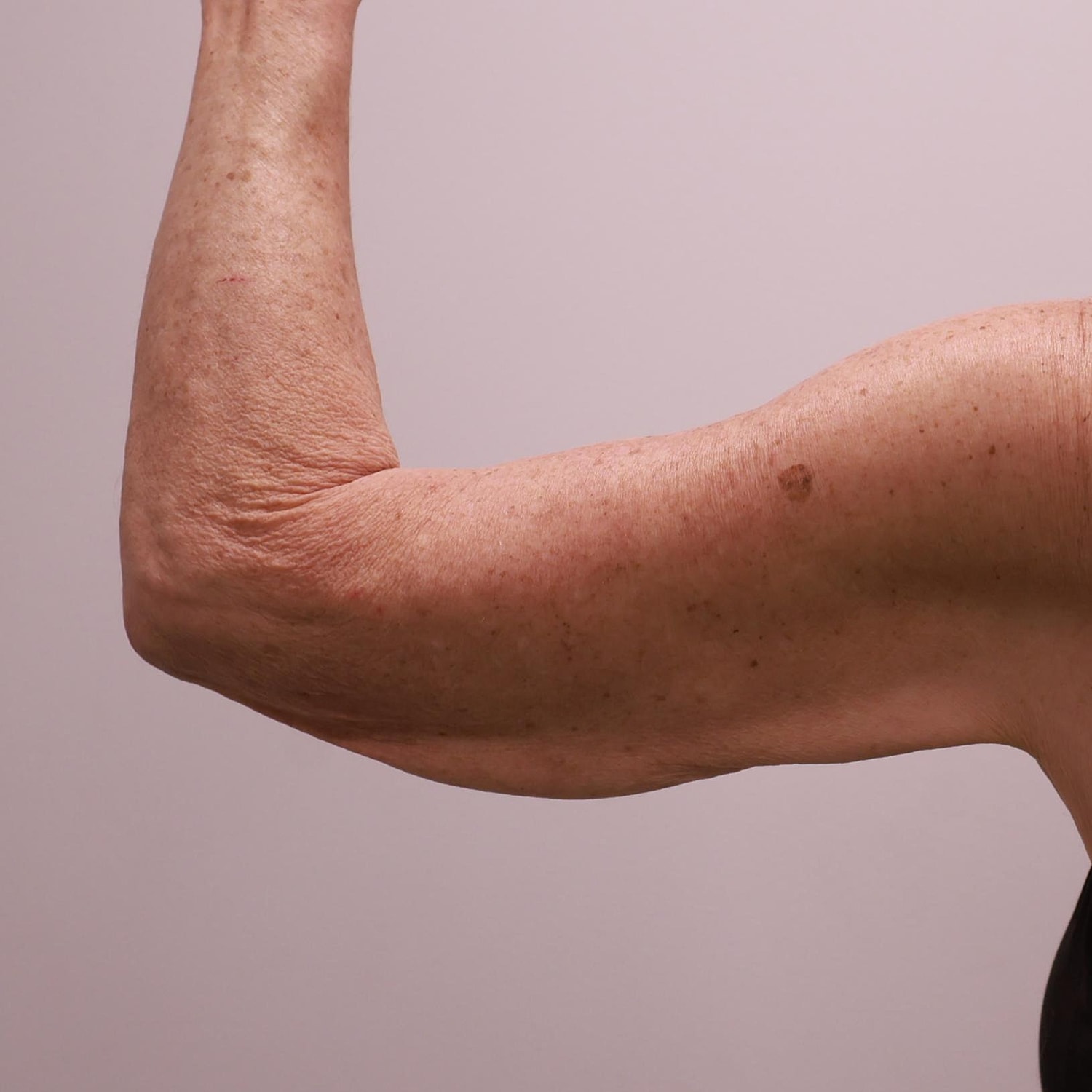 Arm Lift Before & After