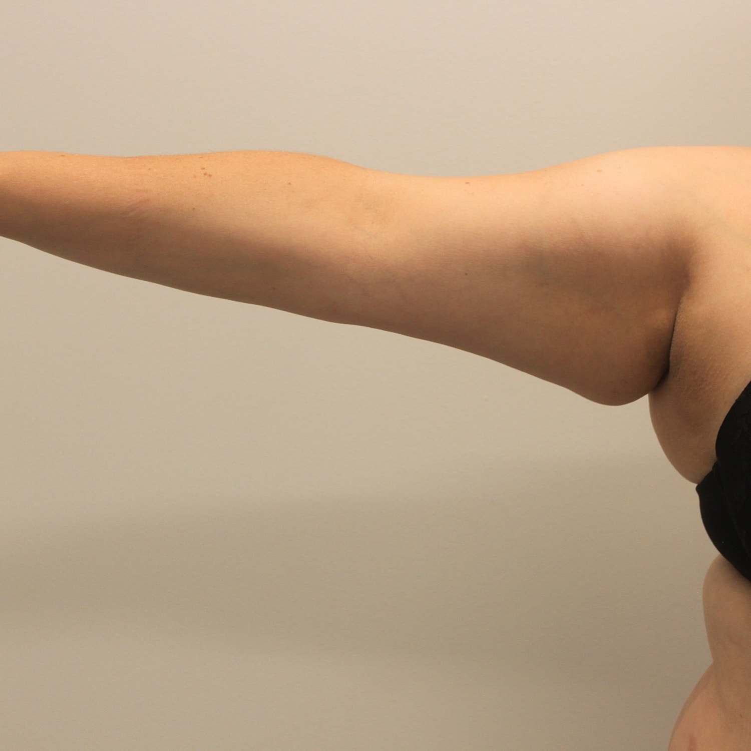 Arm Lift Before & After