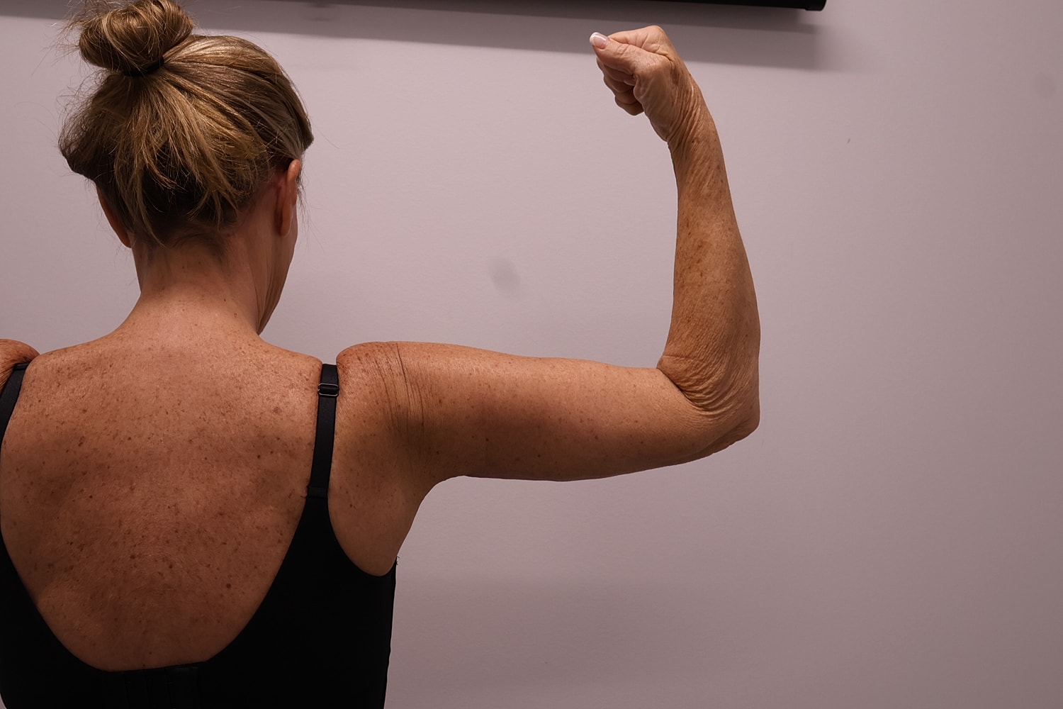 Arm Lift Before & After