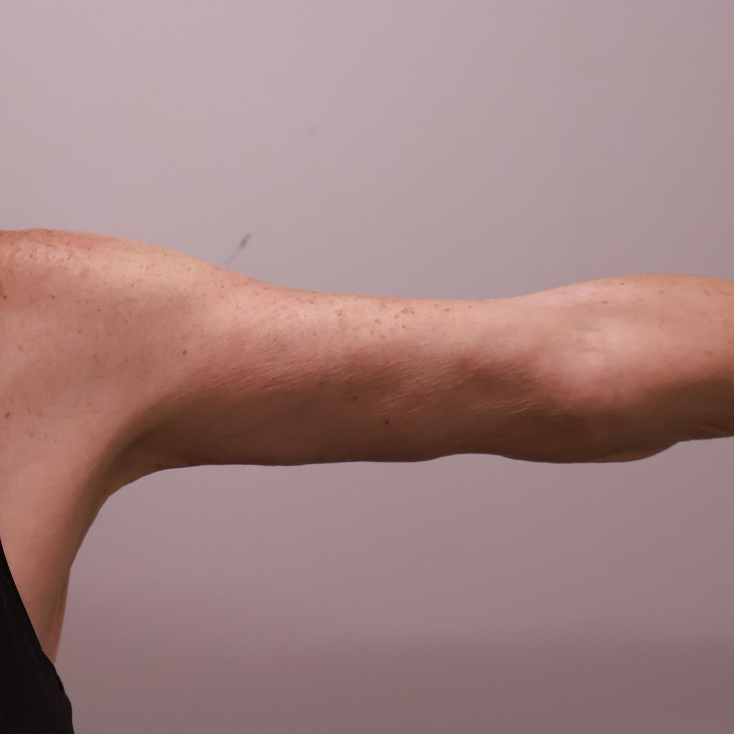 Arm Lift Before & After