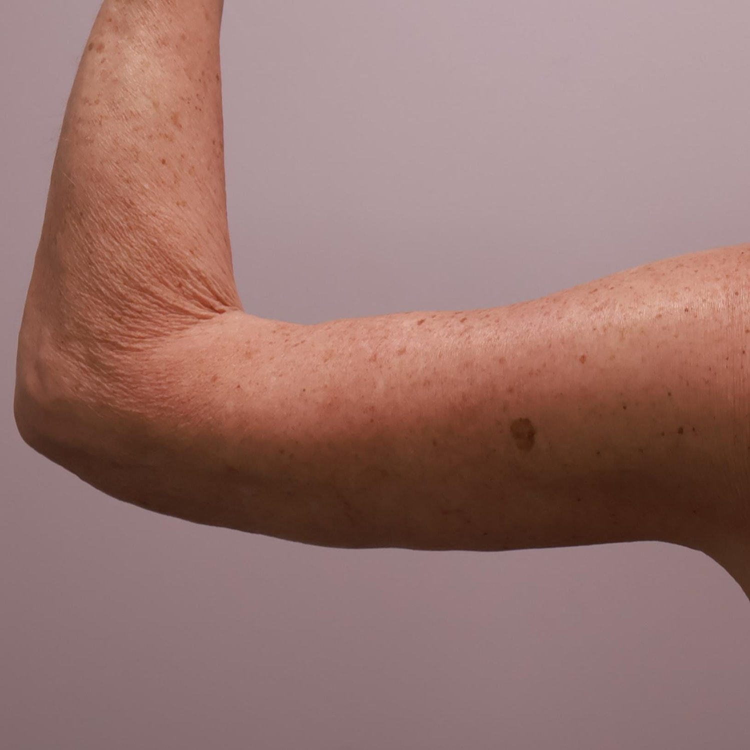 Arm Lift Before & After