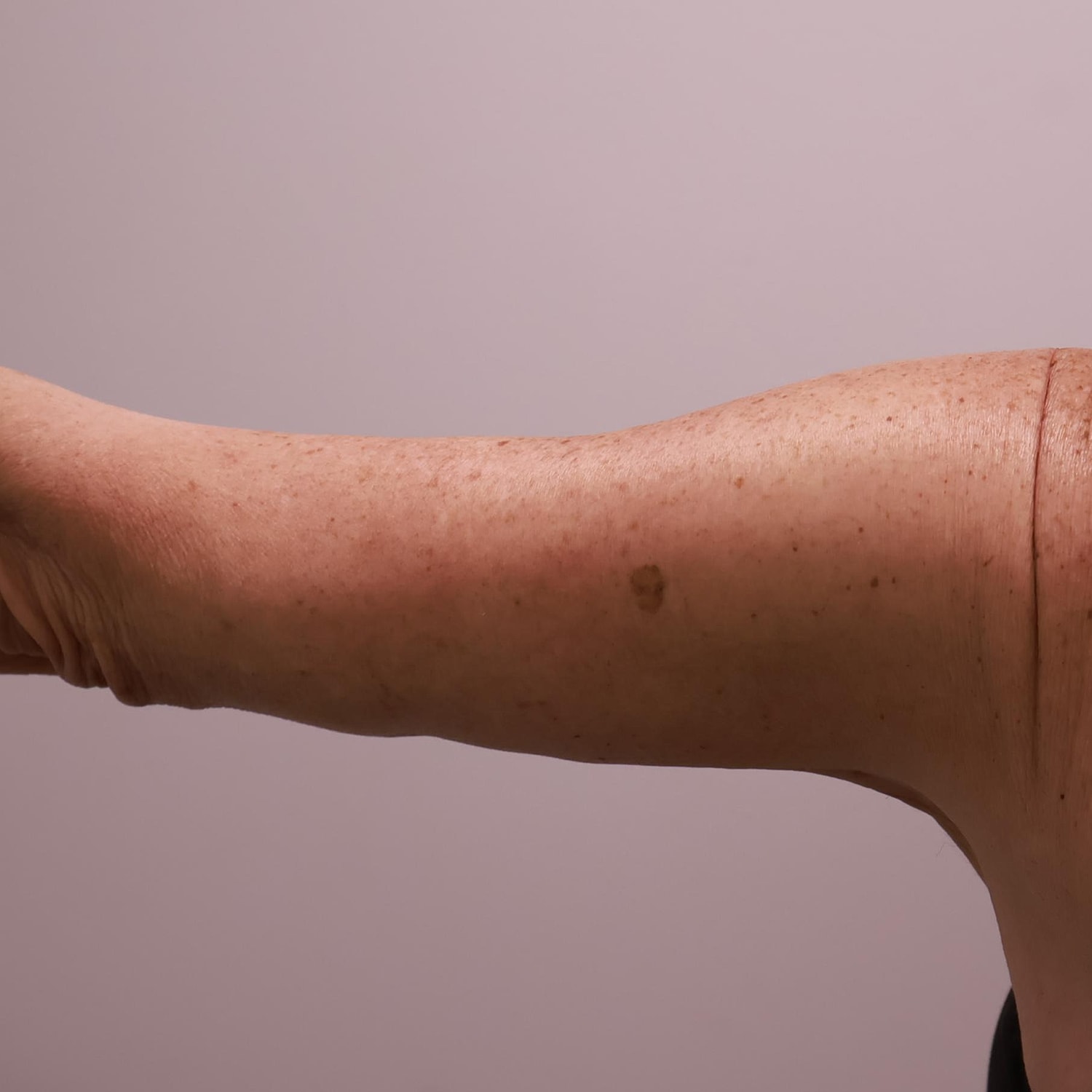 Arm Lift Before & After