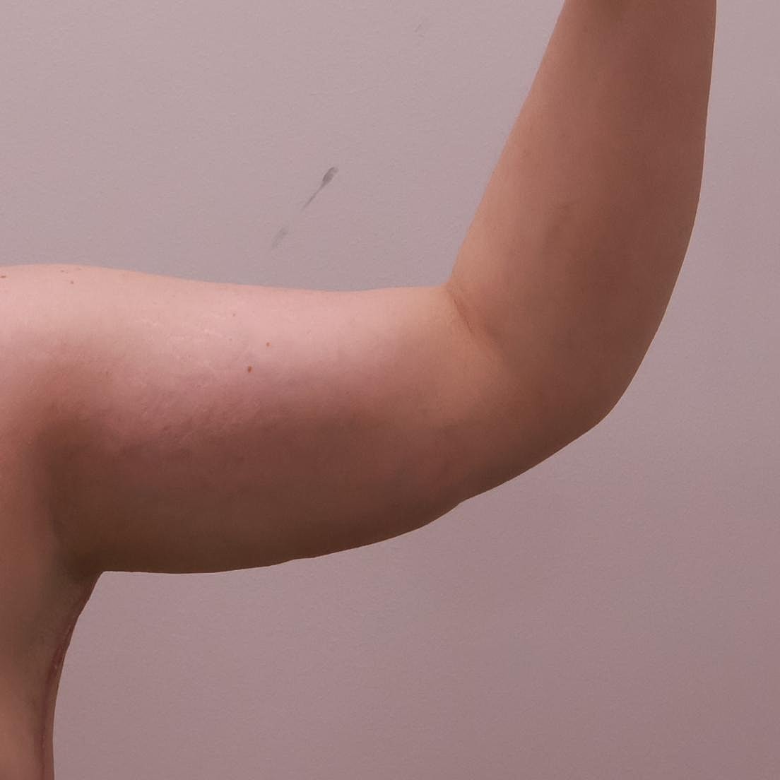 Arm Lift Before & After