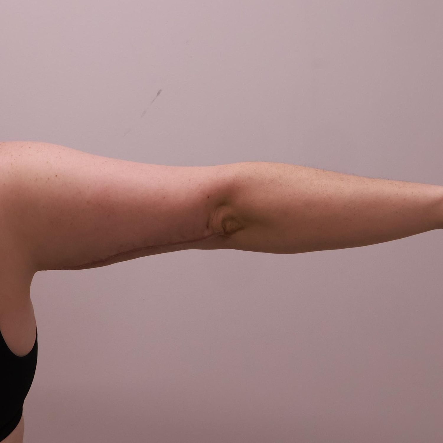 Arm Lift Before & After