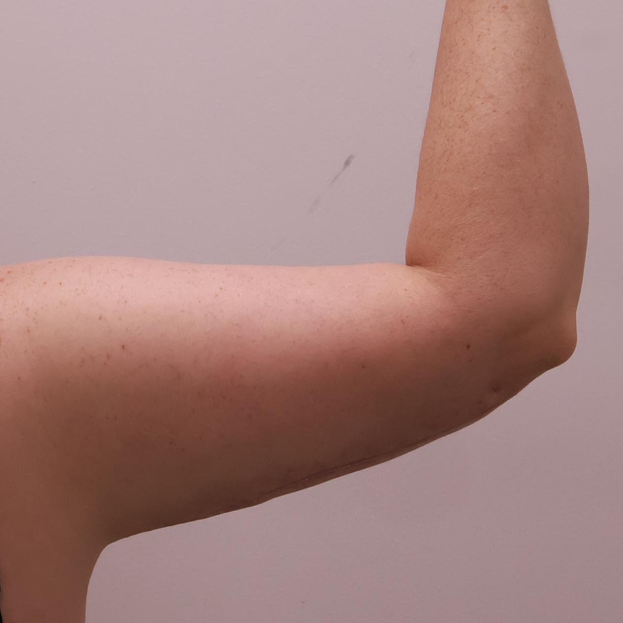 Arm Lift Before & After