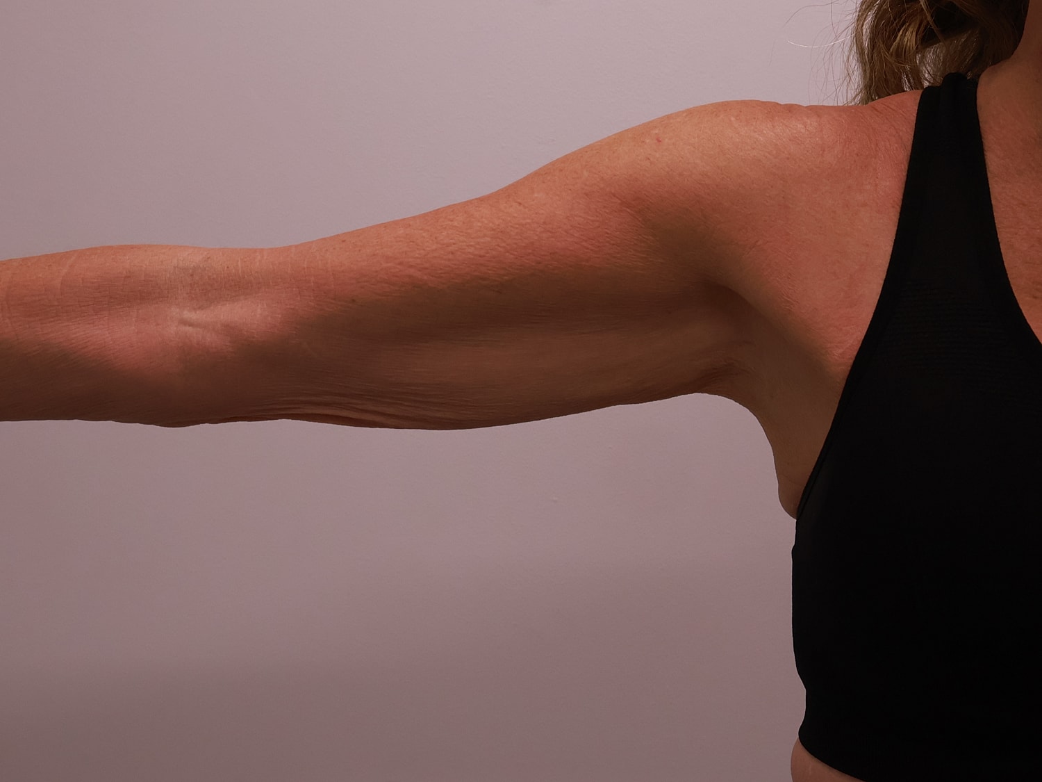 Arm Lift Before & After