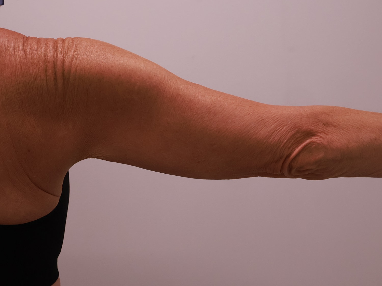 Arm Lift Before & After