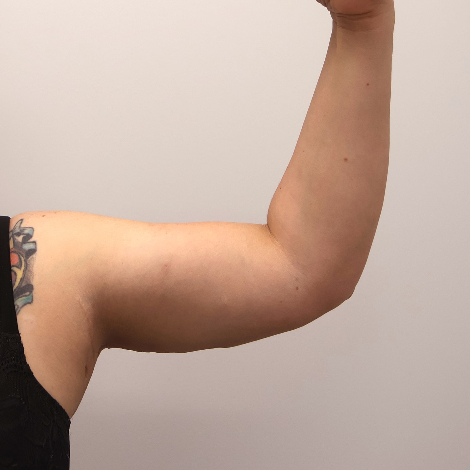 Arm Lift Before & After