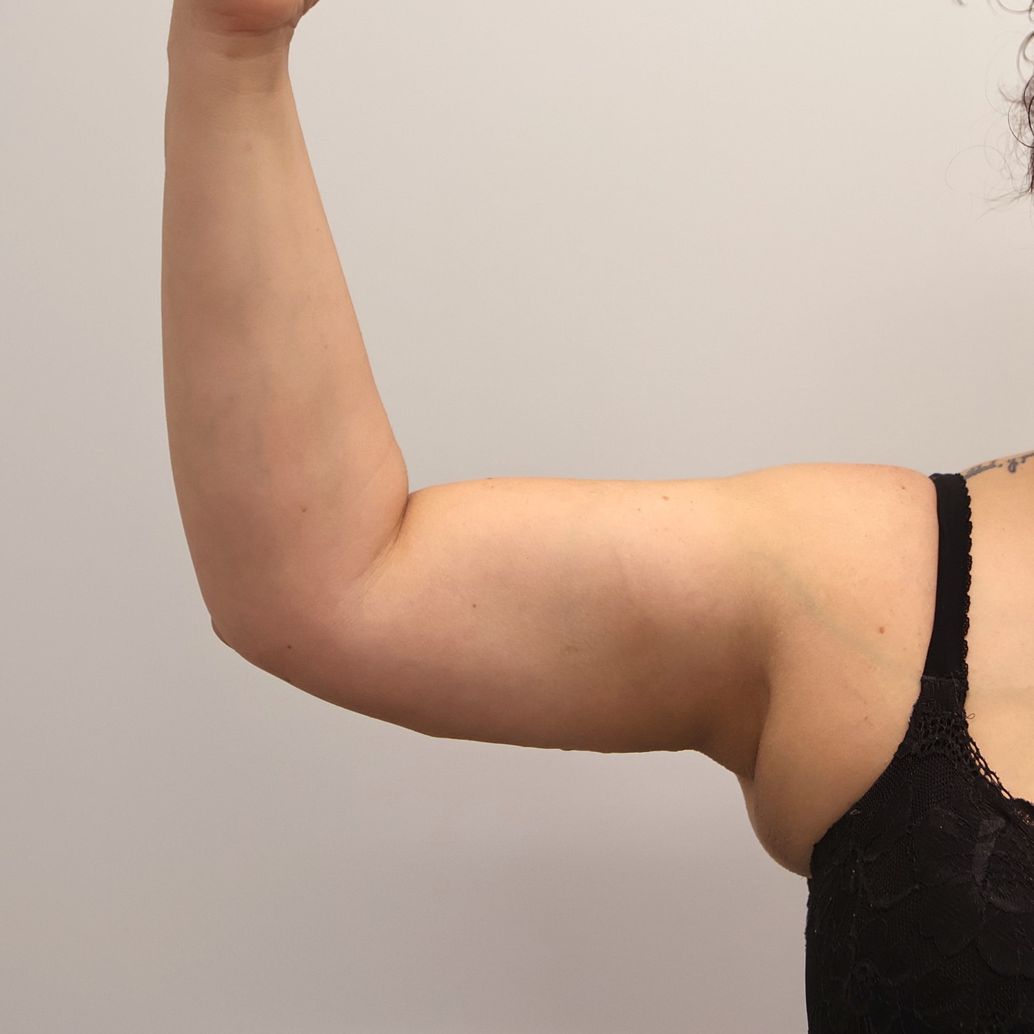 Arm Lift Before & After