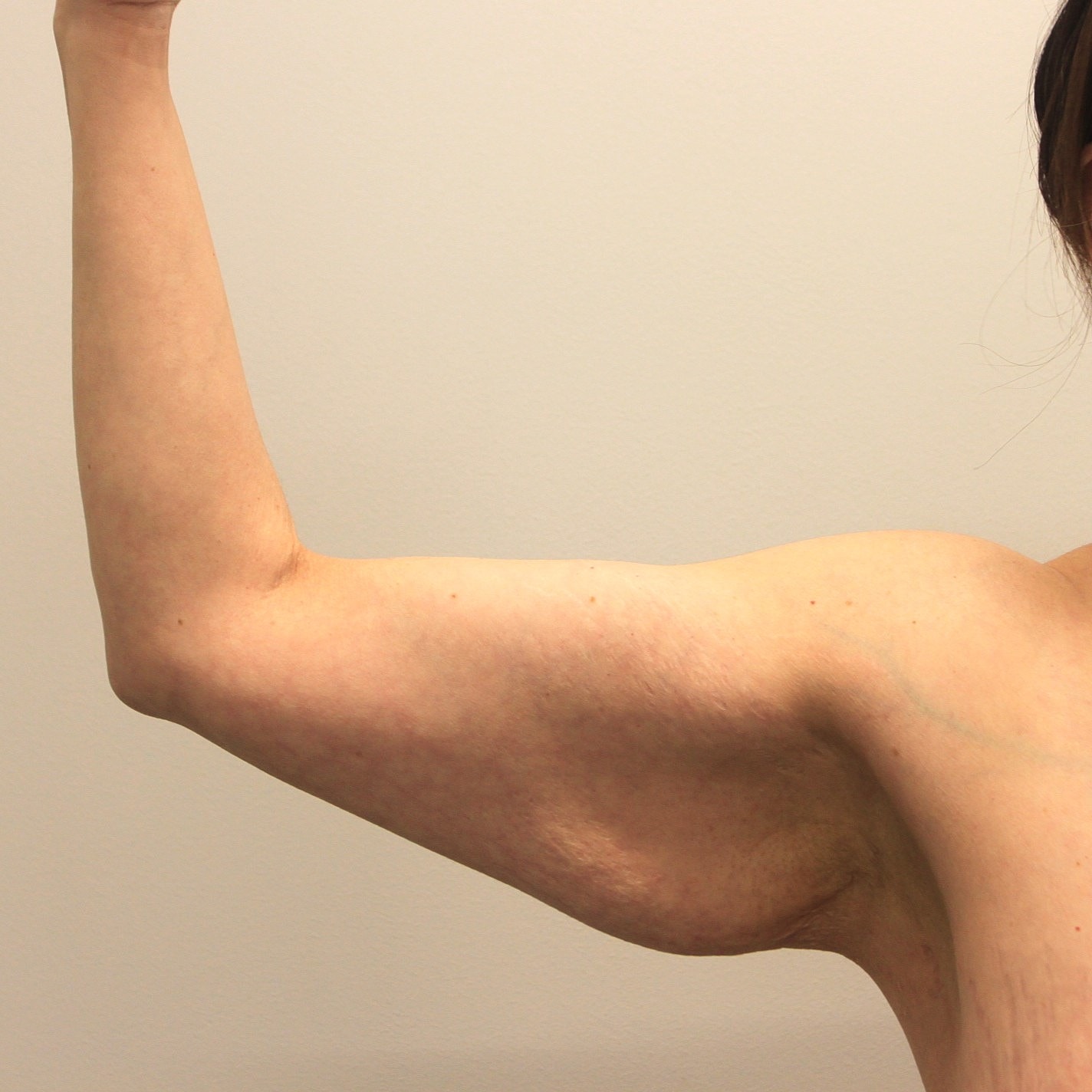 Arm Lift Before & After