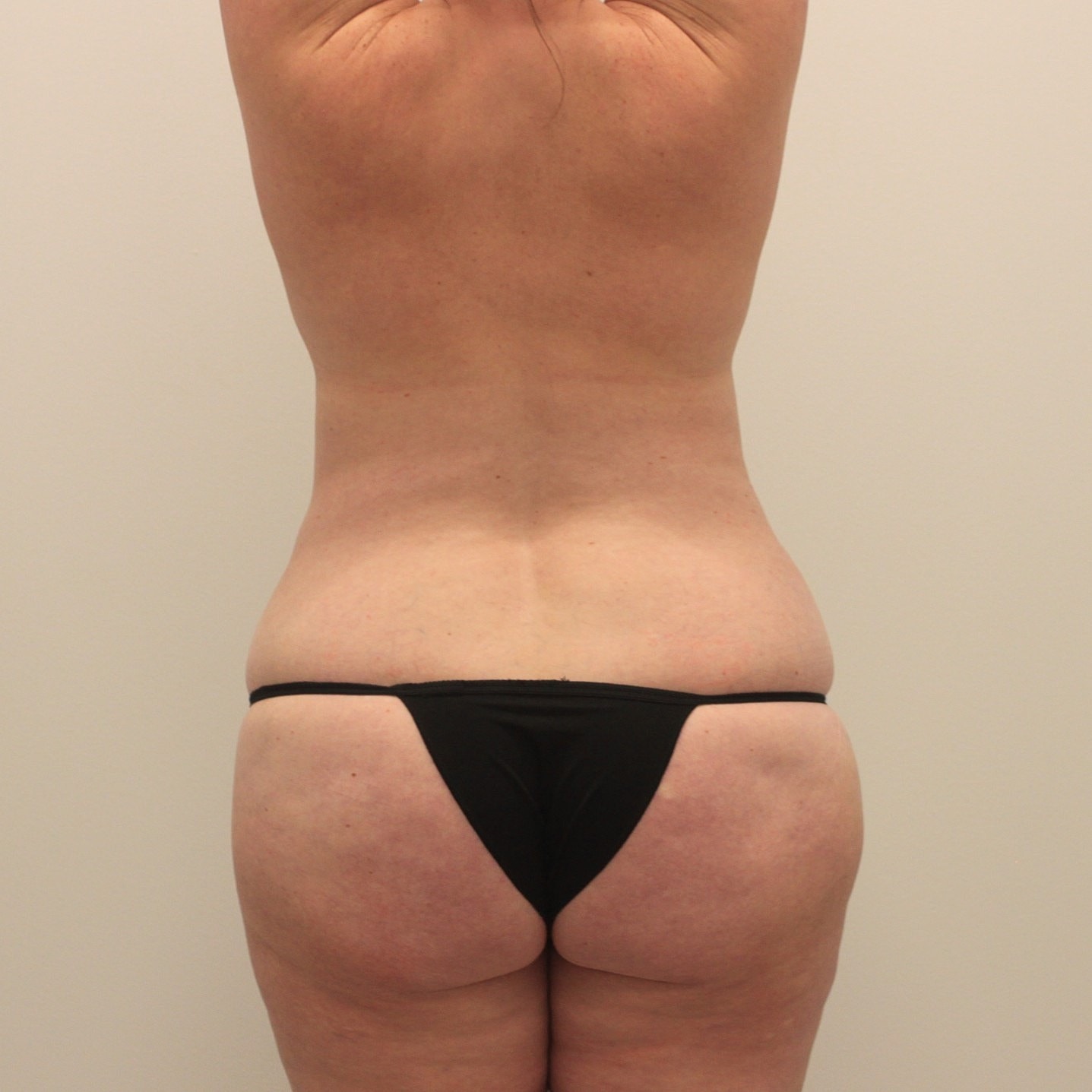 Mommy Makeover Before & After