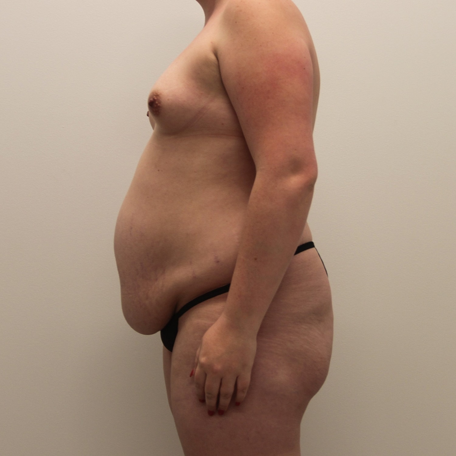 Mommy Makeover Before & After