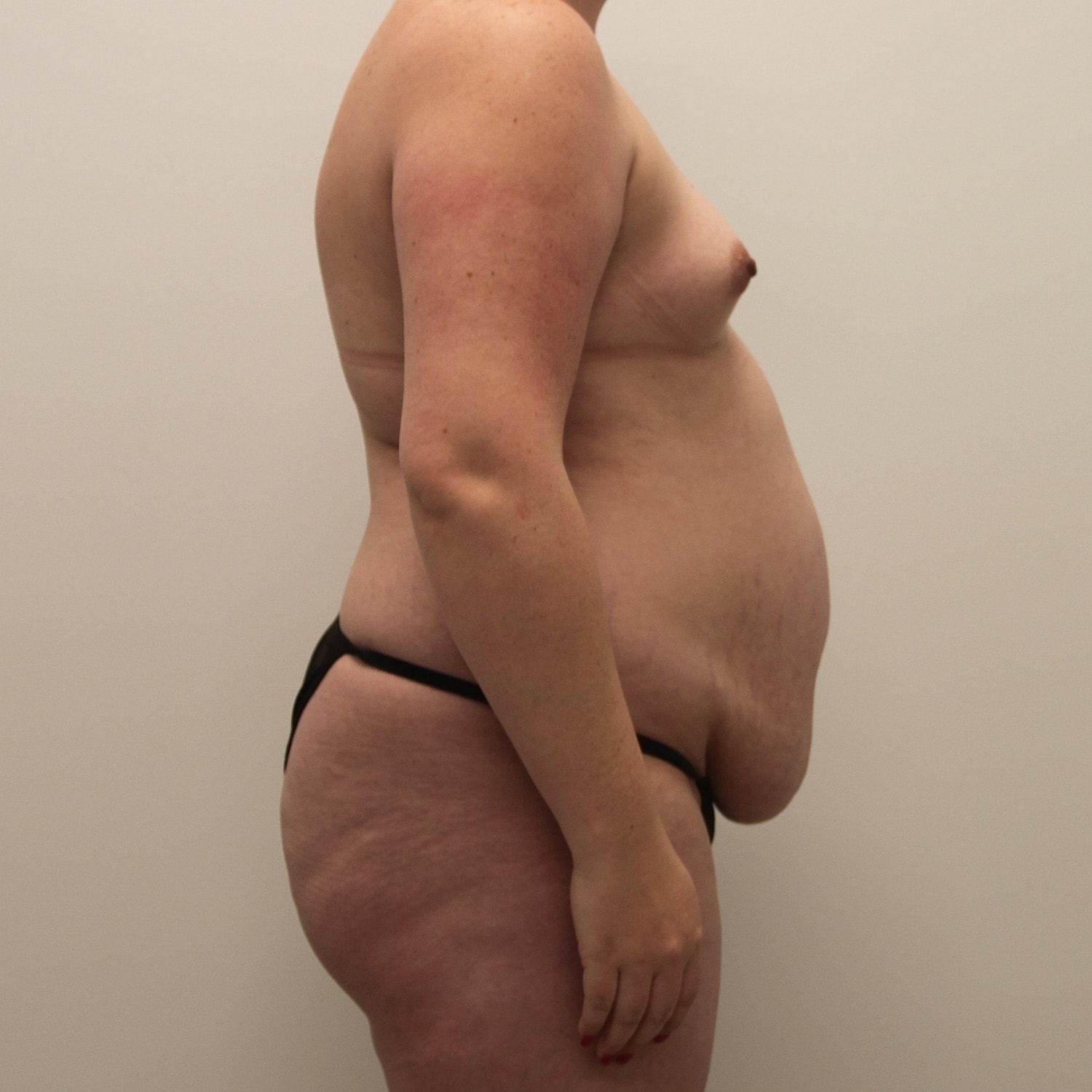 Mommy Makeover Before & After