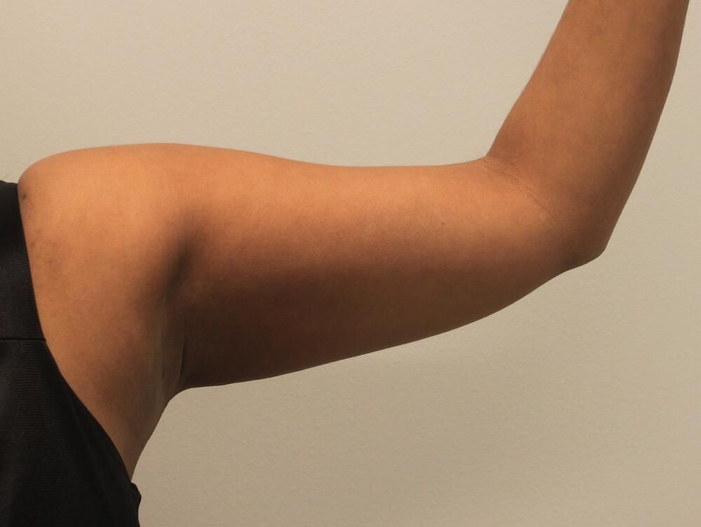 Arm Liposuction Before & After