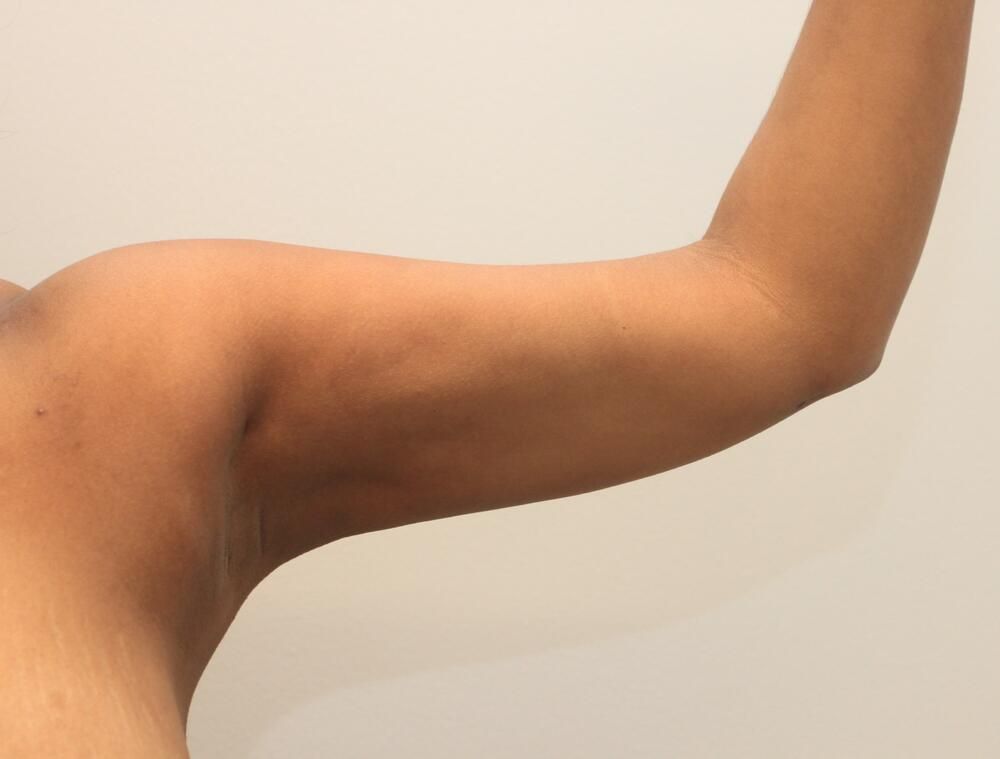Arm Liposuction Before & After