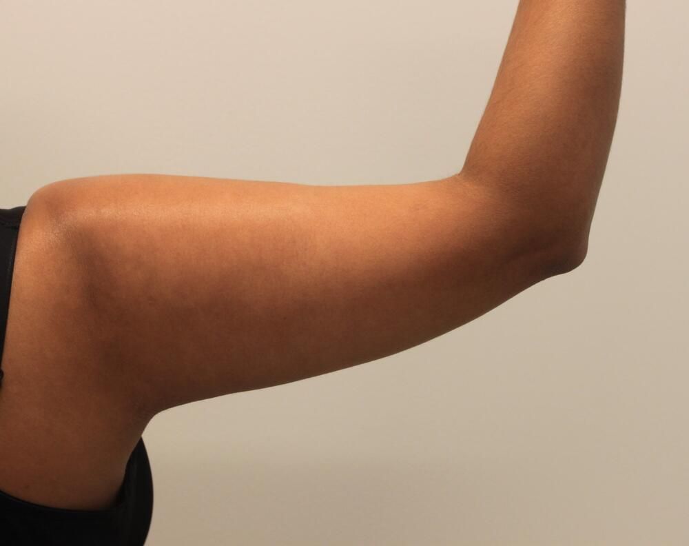 Arm Liposuction Before & After