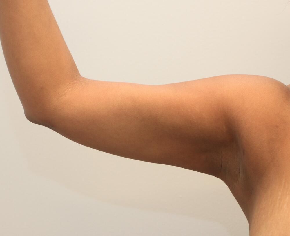 Arm Liposuction Before & After