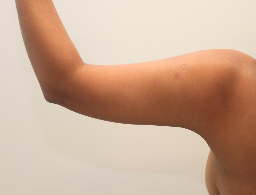 Arm Liposuction Before & After