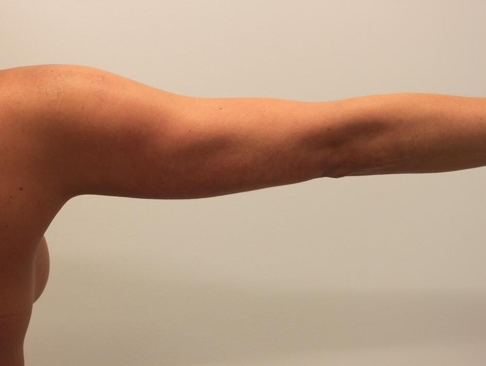 Arm Liposuction Before & After
