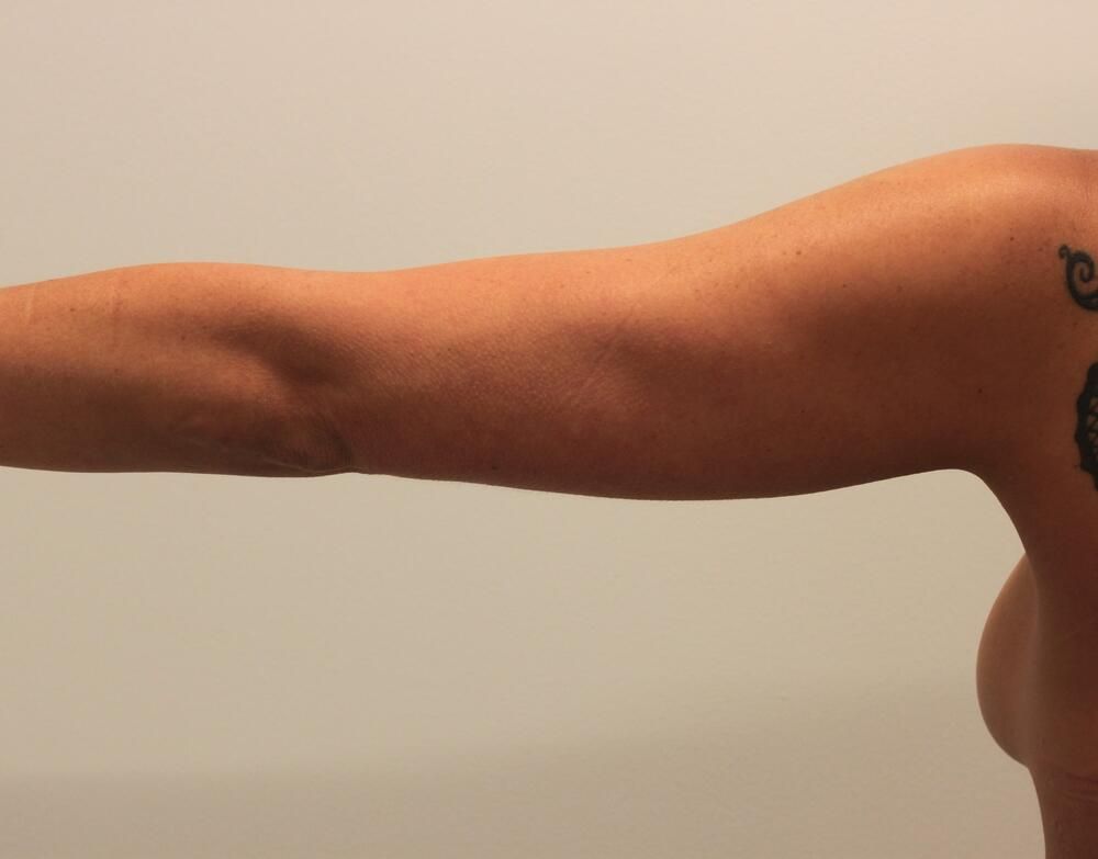 Arm Liposuction Before & After