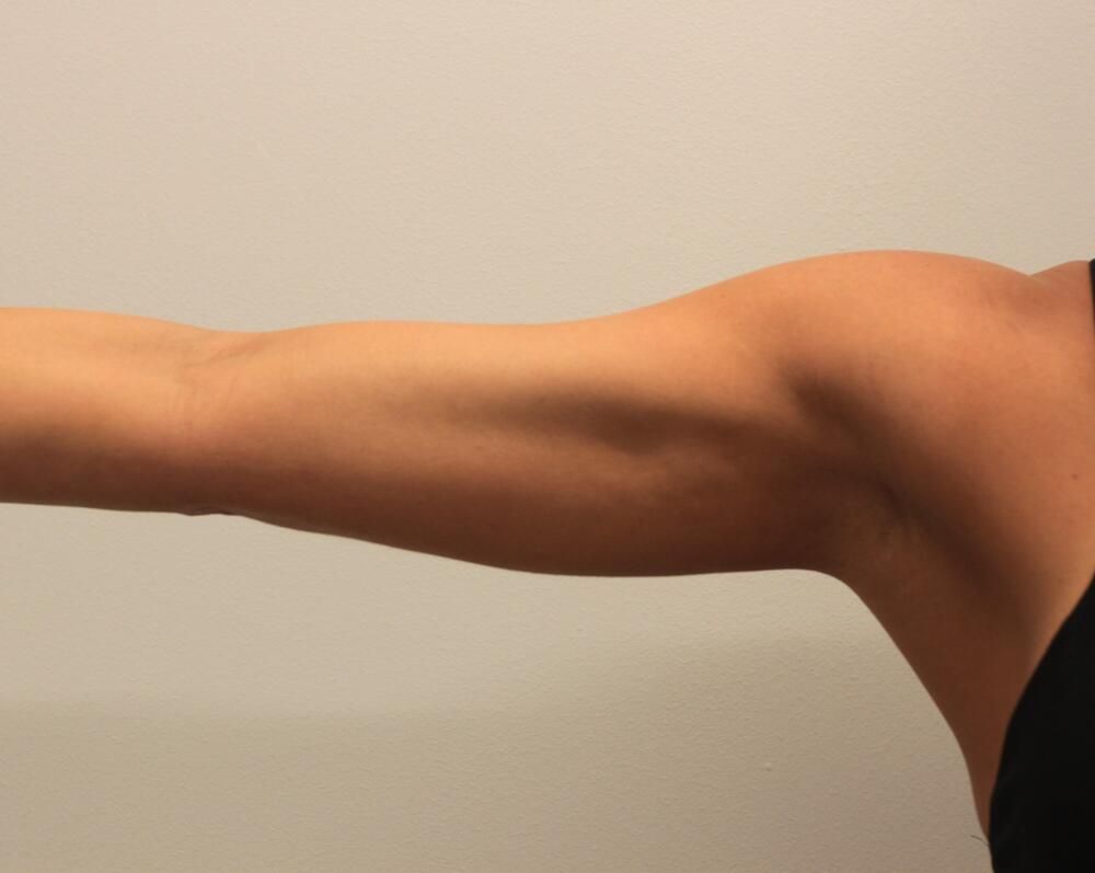 Arm Liposuction Before & After