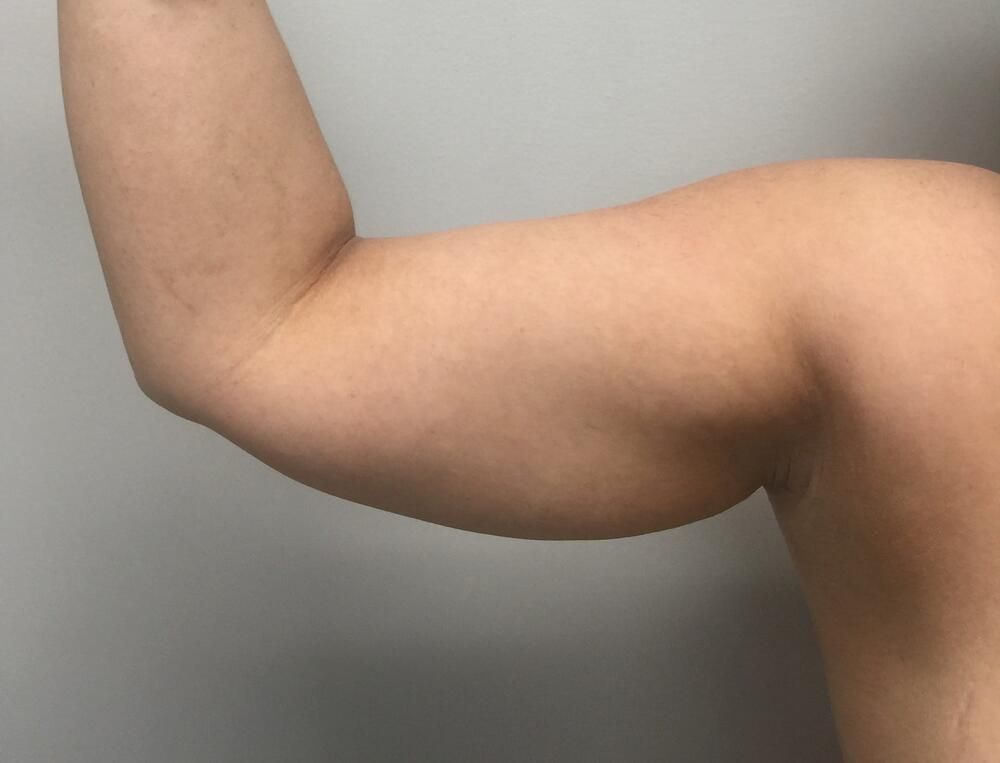 Arm Liposuction Before & After