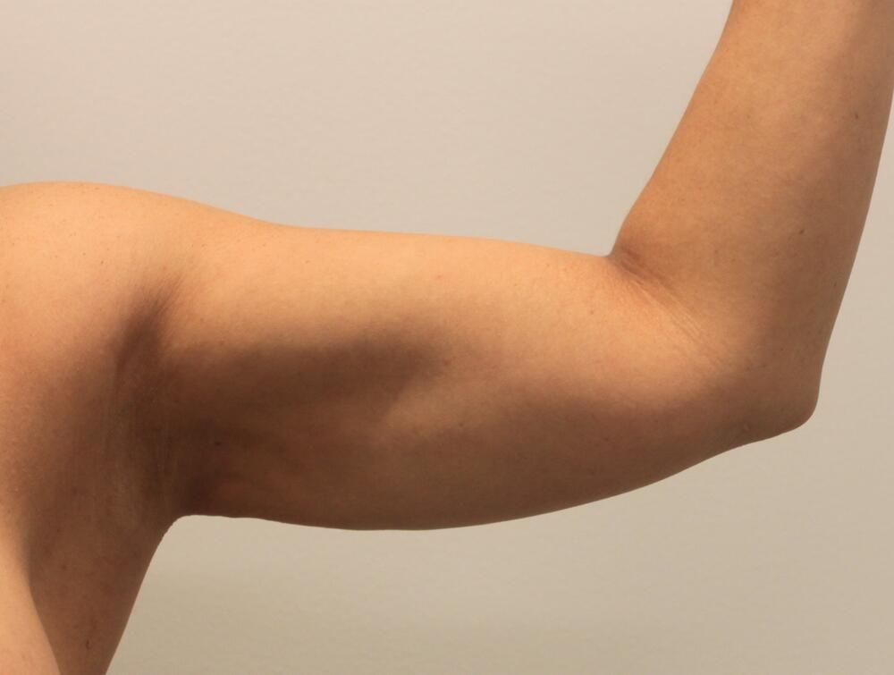 Arm Liposuction Before & After