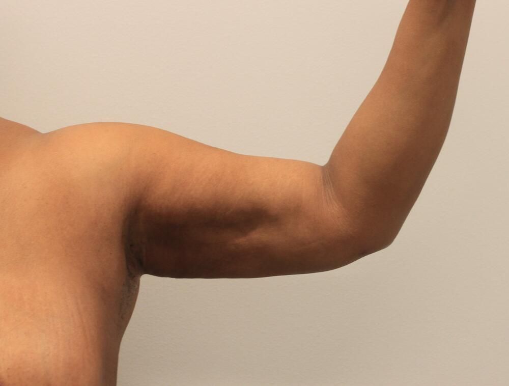 Arm Liposuction Before & After
