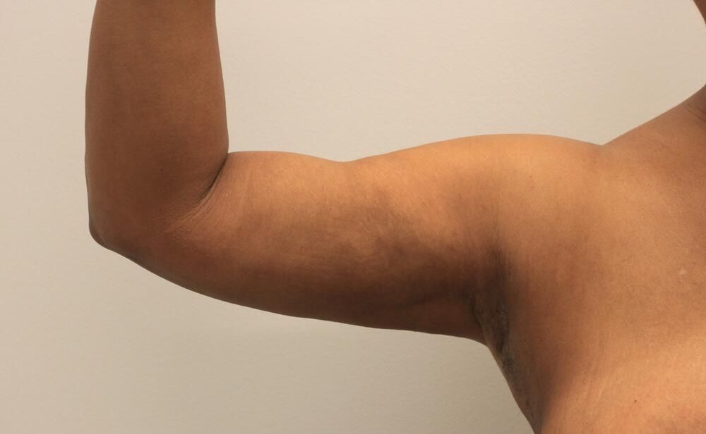 Arm Liposuction Before & After