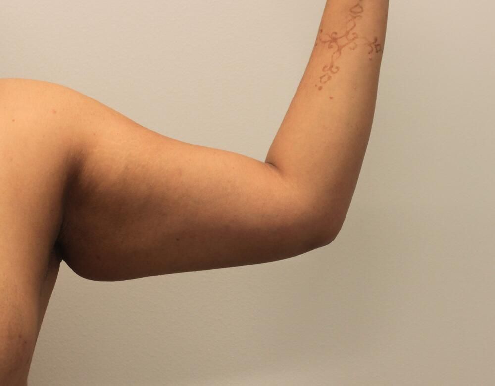 Arm Liposuction Before & After