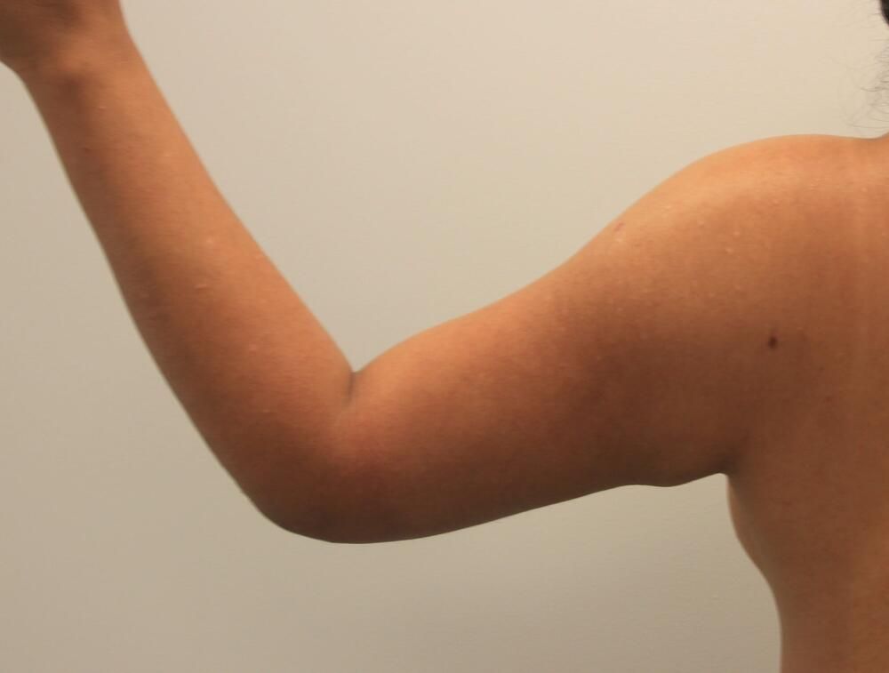 Arm Liposuction Before & After