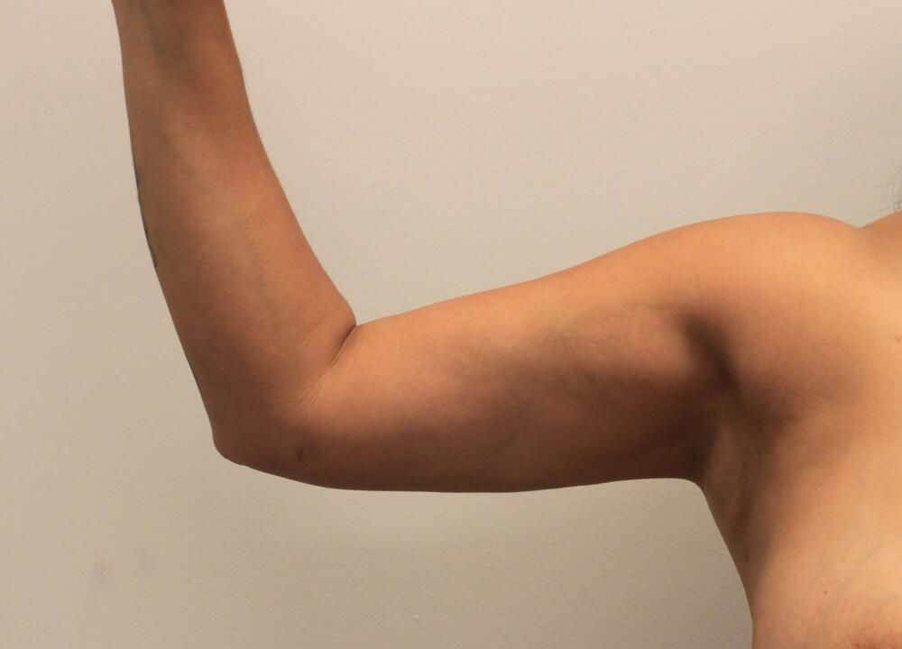 Arm Liposuction Before & After