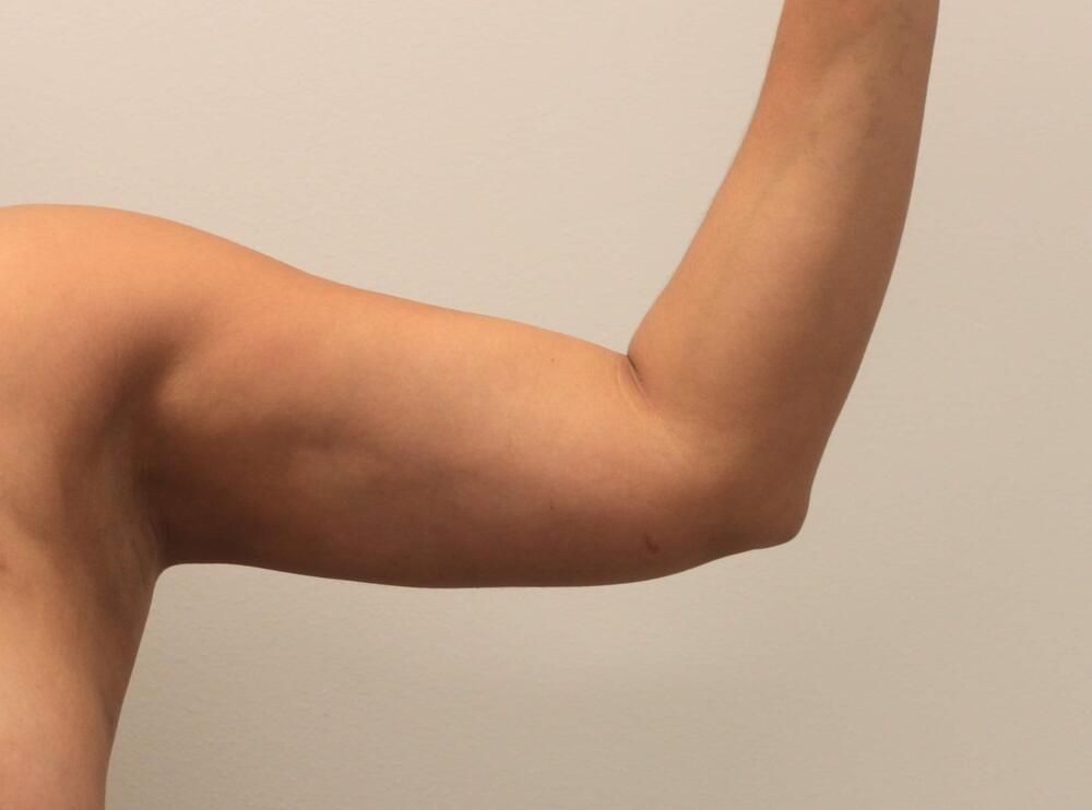 Arm Liposuction Before & After