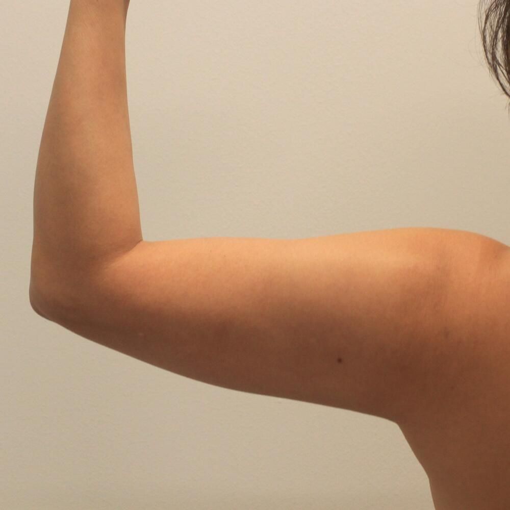 Arm Liposuction Before & After